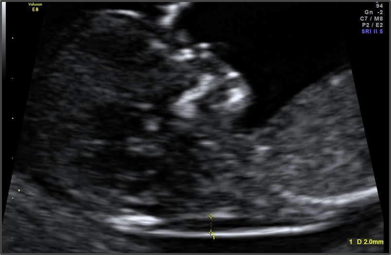 Pregnancy Calculator - Week 12