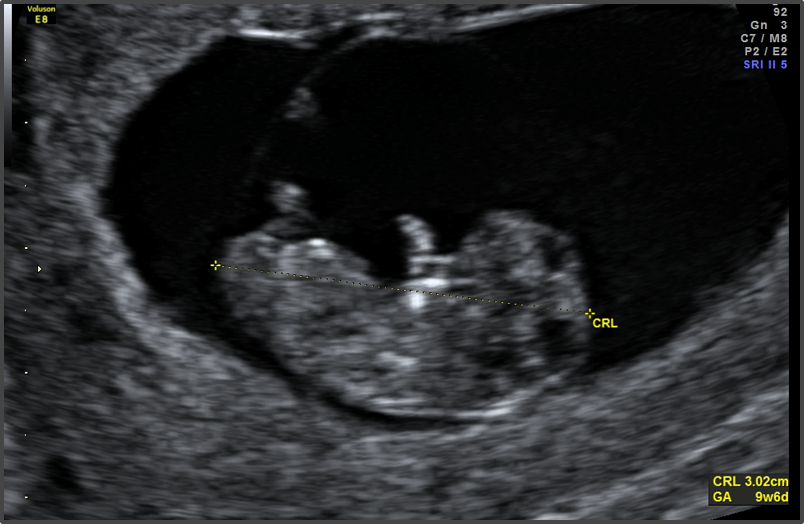 Pregnancy Calculator - Week 9